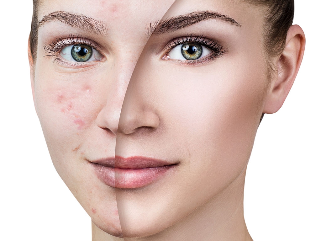 Leke Tedavisi Yöntemleri: En İyi Cilt Yenileme Uygulamaları